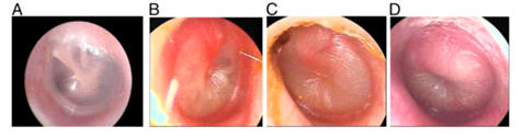 membrana-timpanica